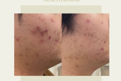 aviclear-before-after