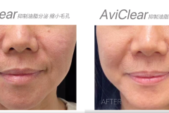 aviclear-before-after